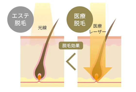 医療レーザー脱毛とエステ脱毛の違い