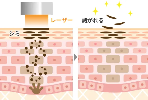 ピコレーザー「エンライトン」のメカニズム